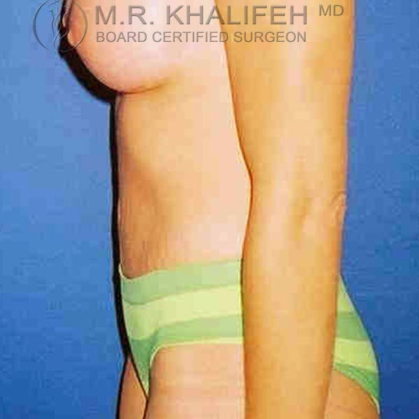 Tummy Tuck Gallery - Patient 3762022 - Image 6