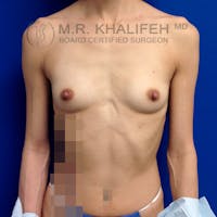 Breast Augmentation Gallery - Patient 3762026 - Image 1