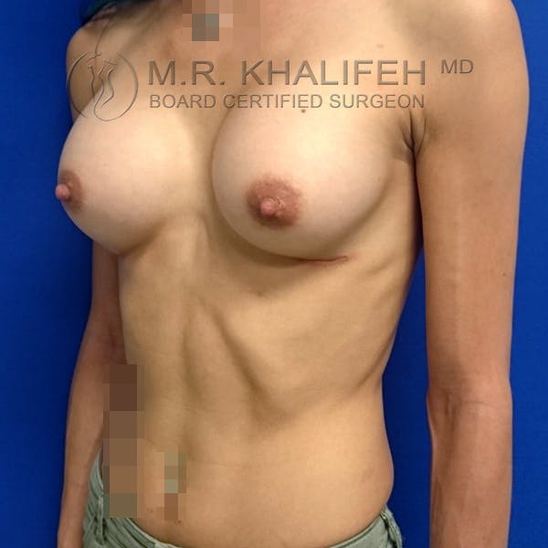 Breast Augmentation Gallery - Patient 3762026 - Image 4