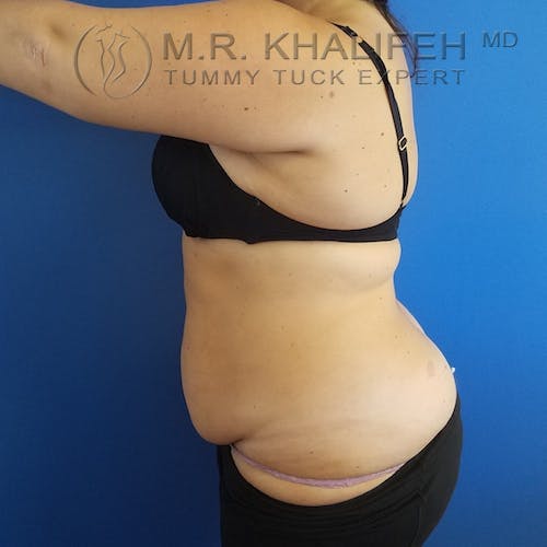 Tummy Tuck Gallery - Patient 3762030 - Image 3