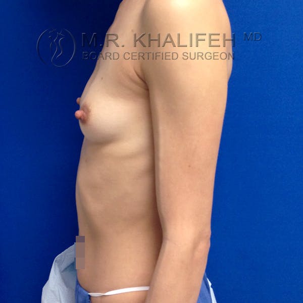 Breast Augmentation Gallery - Patient 3762026 - Image 5