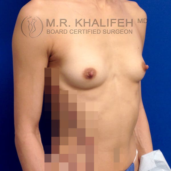 Breast Augmentation Gallery - Patient 3762026 - Image 9