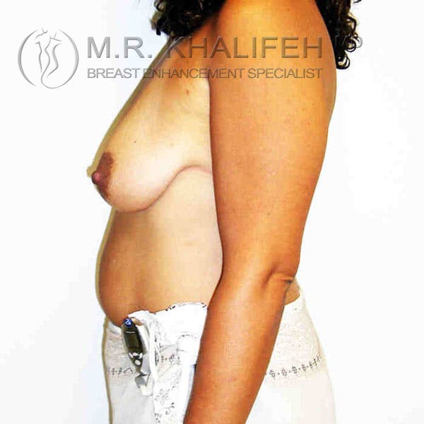 Breast Lift Gallery - Patient 3762029 - Image 3