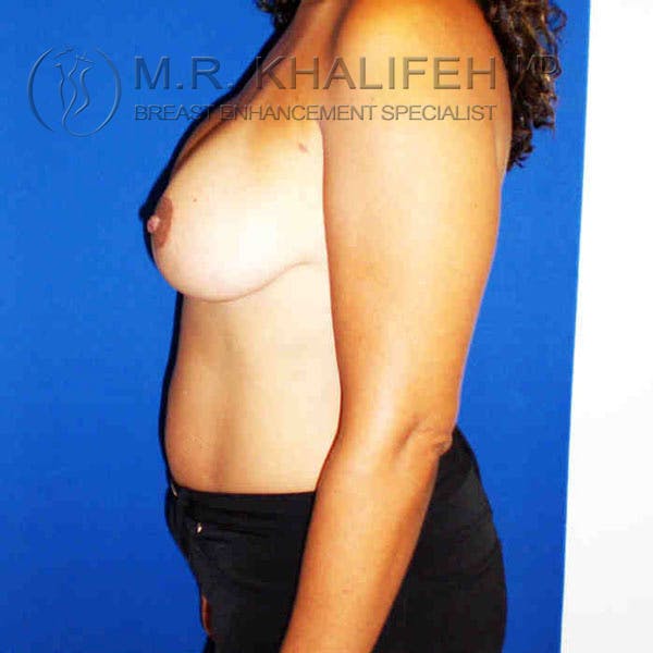 Breast Lift Gallery - Patient 3762029 - Image 4