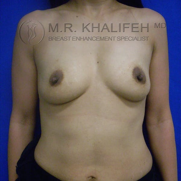 Breast Augmentation Gallery - Patient 3762034 - Image 1