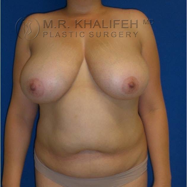 Breast Lift Gallery - Patient 3762033 - Image 1