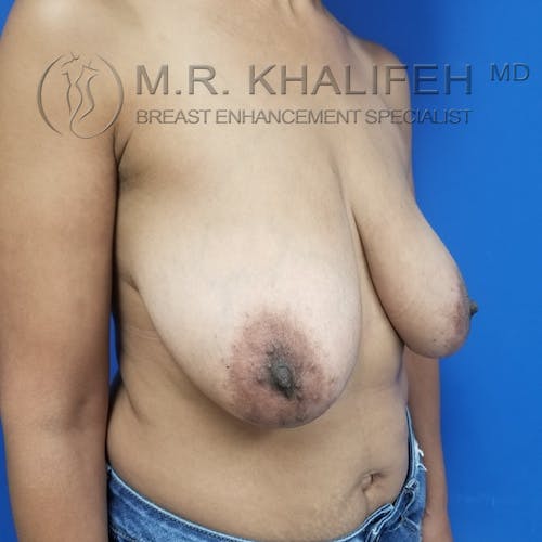 Breast Reduction Gallery - Patient 3762036 - Image 3