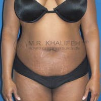 Tummy Tuck Gallery - Patient 3762037 - Image 1