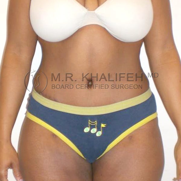 Tummy Tuck Gallery - Patient 3762037 - Image 2