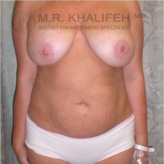 Breast Lift Gallery - Patient 3762038 - Image 1