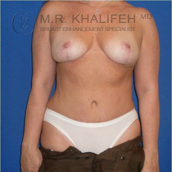 Breast Lift Gallery - Patient 3762038 - Image 2
