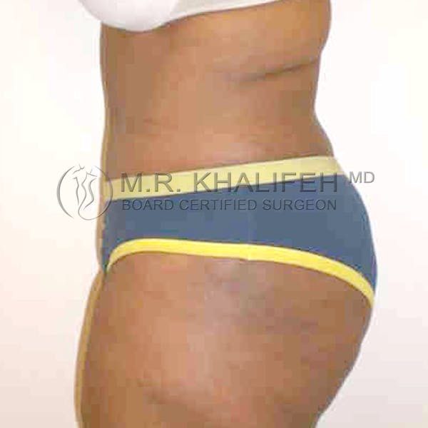 Tummy Tuck Gallery - Patient 3762037 - Image 4