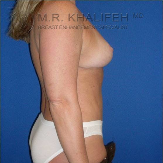 Breast Lift Gallery - Patient 3762038 - Image 4