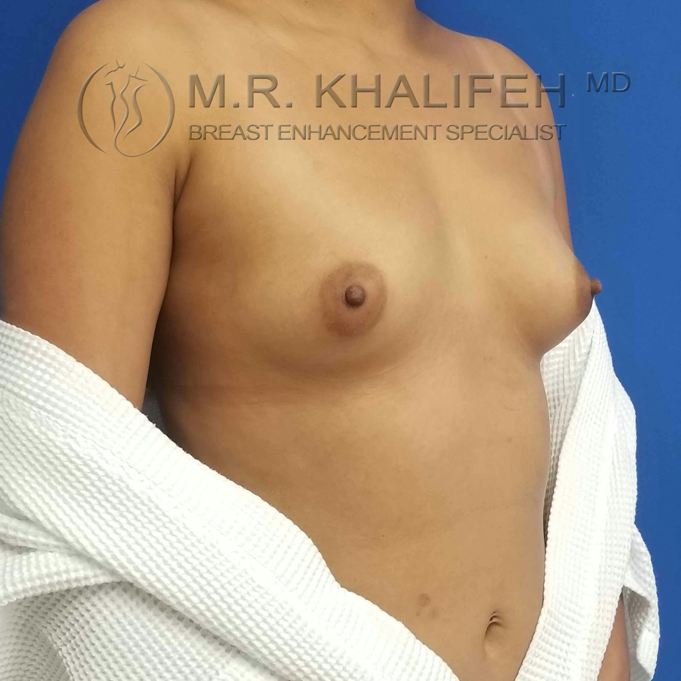 Breast Augmentation Gallery - Patient 3762044 - Image 3