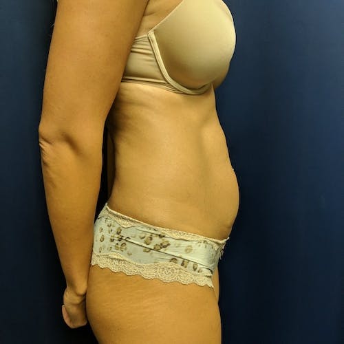 Tummy Tuck Gallery - Patient 3762041 - Image 5