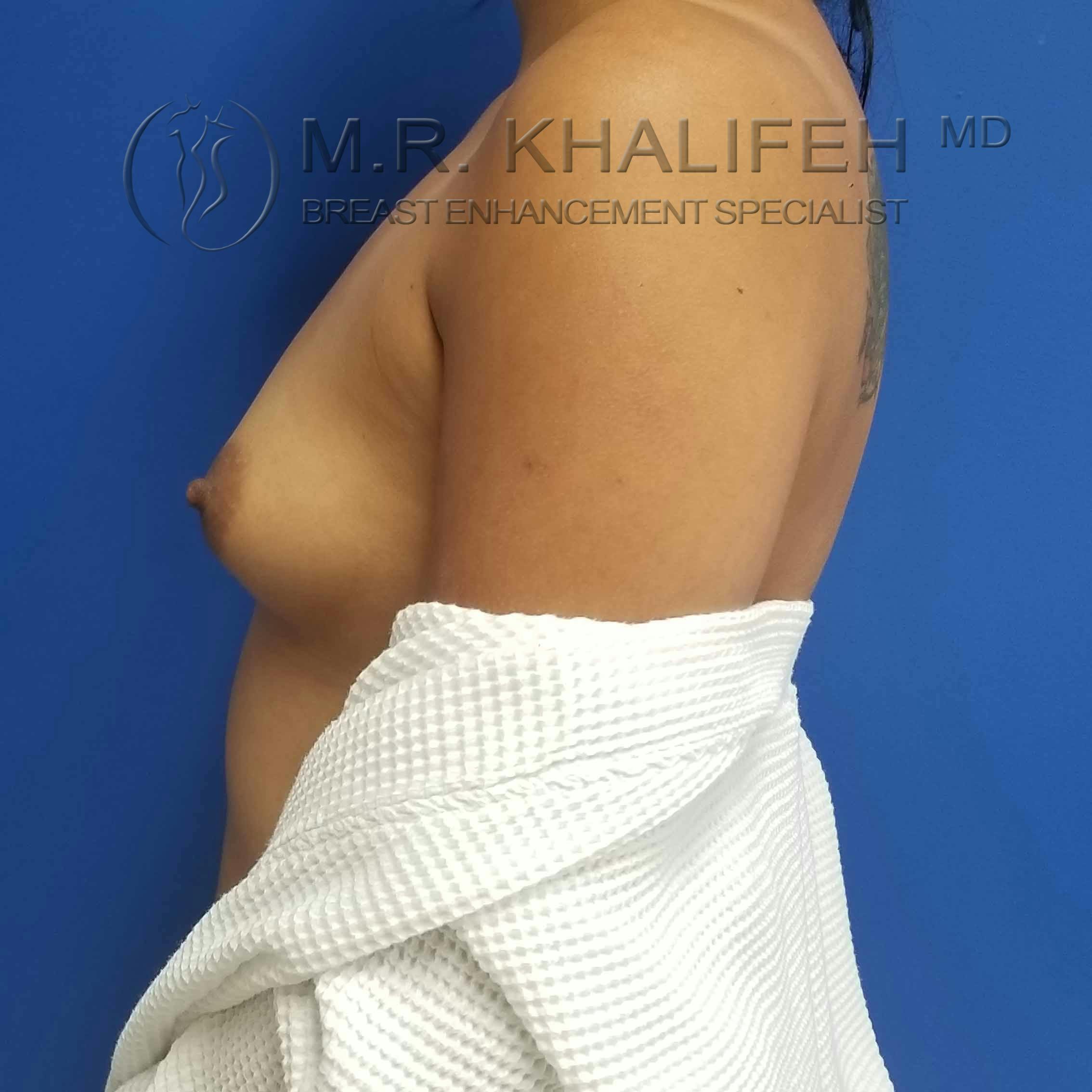 Breast Augmentation Gallery - Patient 3762044 - Image 9
