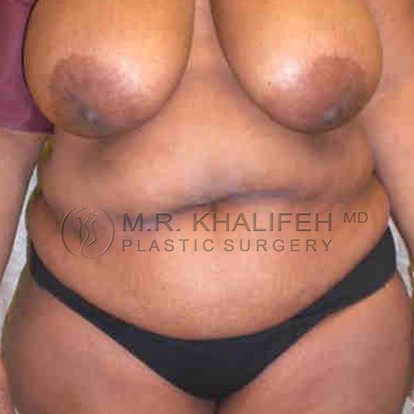 Tummy Tuck Gallery - Patient 3762050 - Image 1