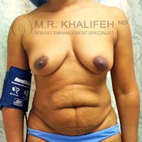 Breast Augmentation Gallery - Patient 3762049 - Image 1