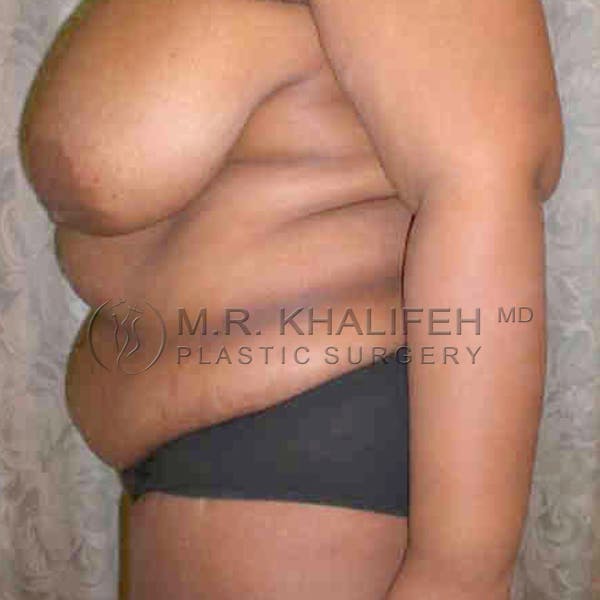Tummy Tuck Gallery - Patient 3762050 - Image 3