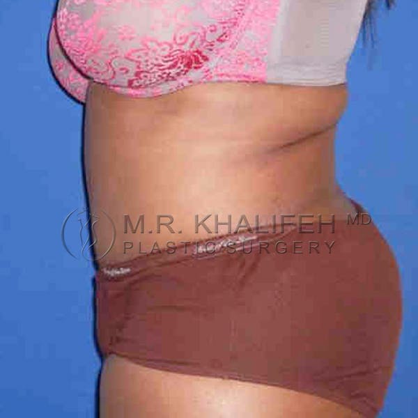 Tummy Tuck Gallery - Patient 3762050 - Image 4