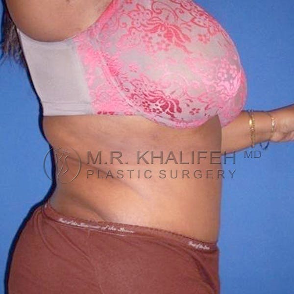 Tummy Tuck Gallery - Patient 3762050 - Image 6