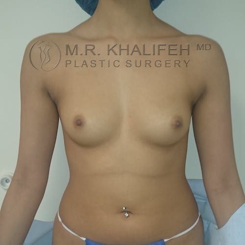 Breast Augmentation Gallery - Patient 3762052 - Image 1