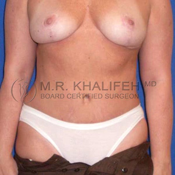 Tummy Tuck Gallery - Patient 3762051 - Image 2