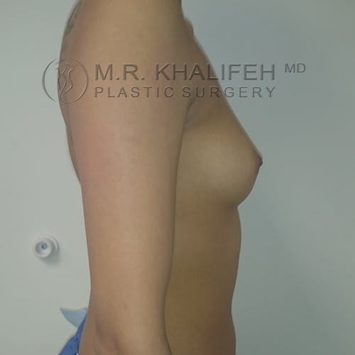 Breast Augmentation Gallery - Patient 3762052 - Image 5