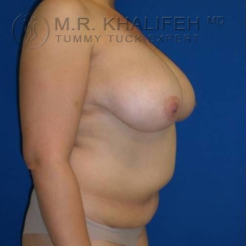 Tummy Tuck Gallery - Patient 3762054 - Image 3