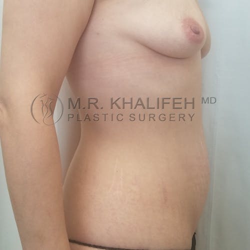 Breast Augmentation Gallery - Patient 3762056 - Image 3