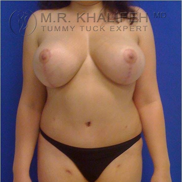 Tummy Tuck Gallery - Patient 3762054 - Image 2
