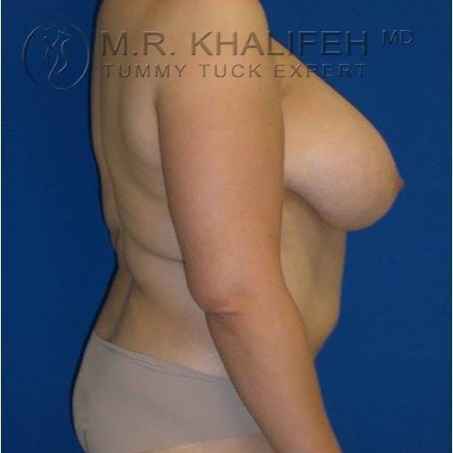 Tummy Tuck Gallery - Patient 3762054 - Image 5