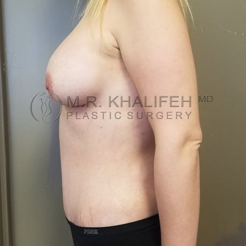 Breast Augmentation Gallery - Patient 3762056 - Image 8