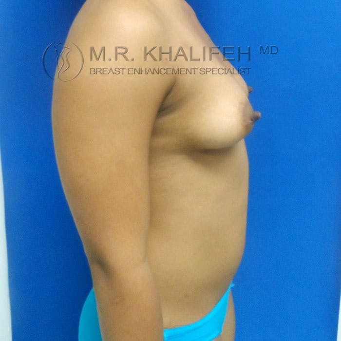 Breast Augmentation Gallery - Patient 3762064 - Image 5