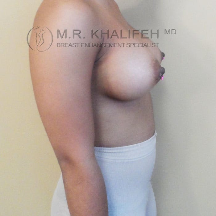 Breast Augmentation Gallery - Patient 3762064 - Image 6