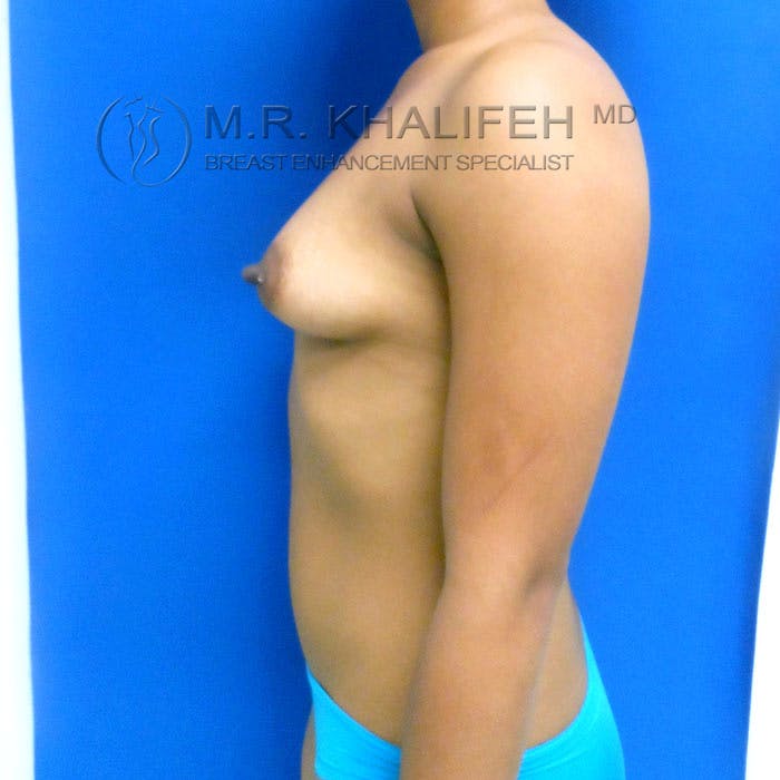 Breast Augmentation Gallery - Patient 3762064 - Image 7