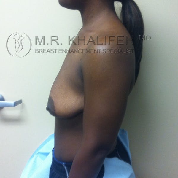 Breast Lift Gallery - Patient 3762065 - Image 5