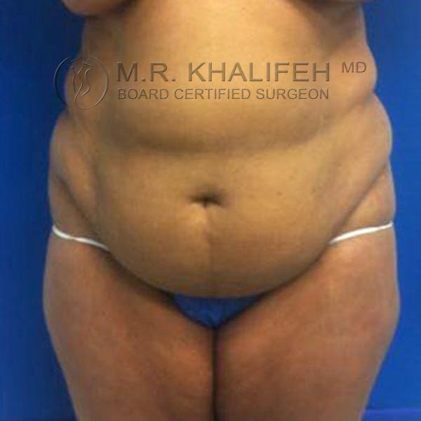 Tummy Tuck Gallery - Patient 3762067 - Image 1