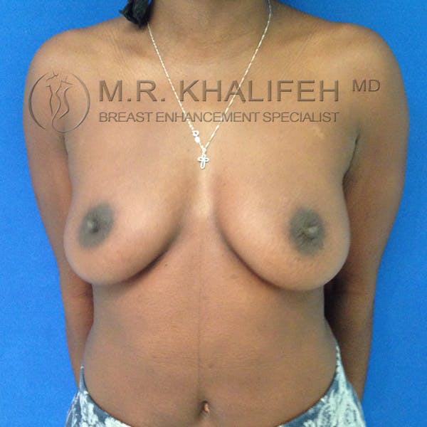 Breast Augmentation Gallery - Patient 3762069 - Image 1
