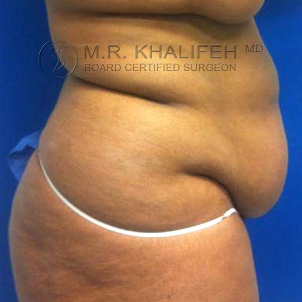 Tummy Tuck Gallery - Patient 3762067 - Image 5