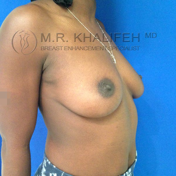 Breast Augmentation Gallery - Patient 3762069 - Image 3