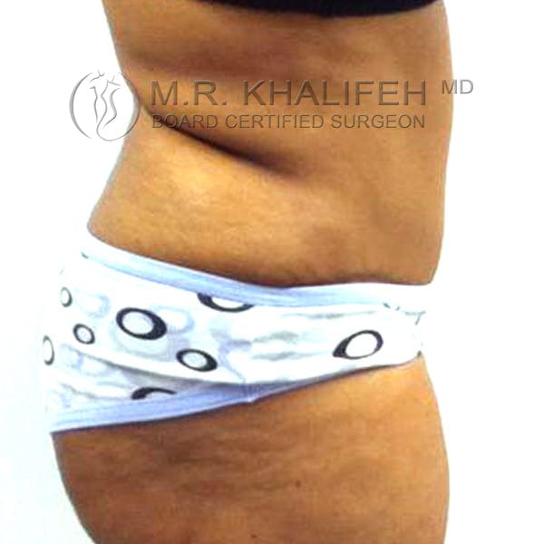 Tummy Tuck Gallery - Patient 3762067 - Image 6