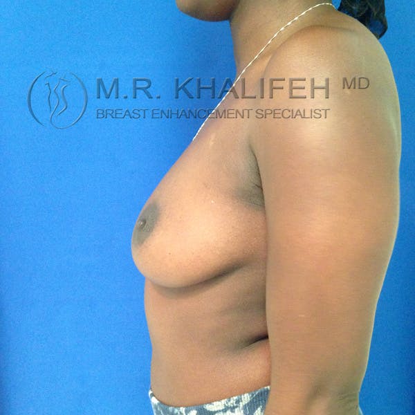 Breast Augmentation Gallery - Patient 3762069 - Image 7