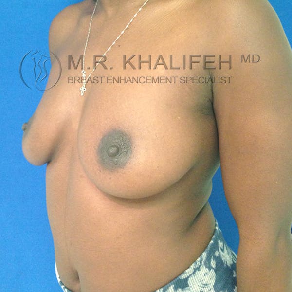 Breast Augmentation Gallery - Patient 3762069 - Image 9