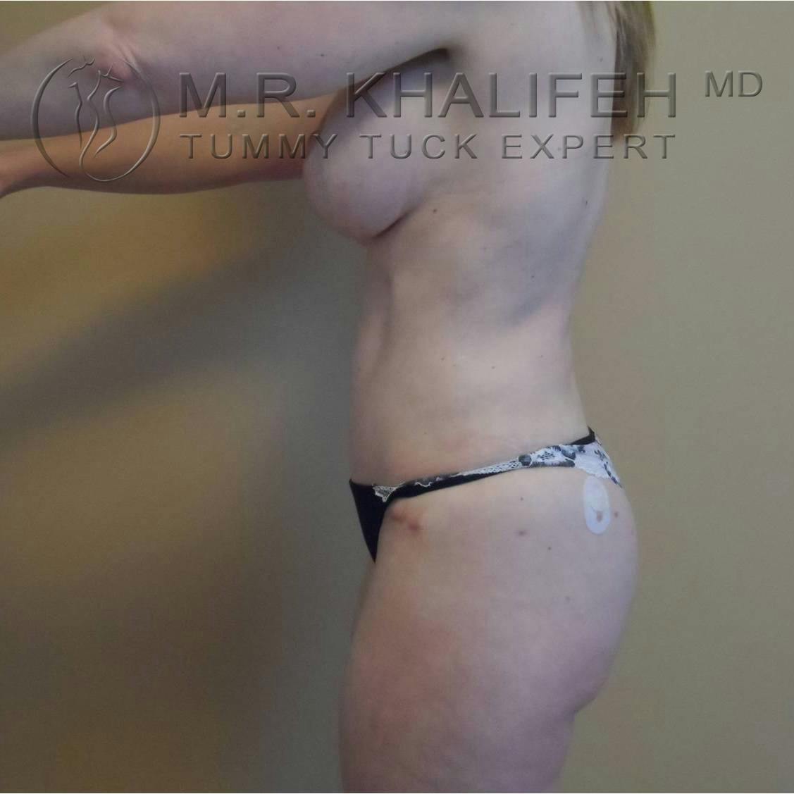 Tummy Tuck Gallery - Patient 3762071 - Image 4