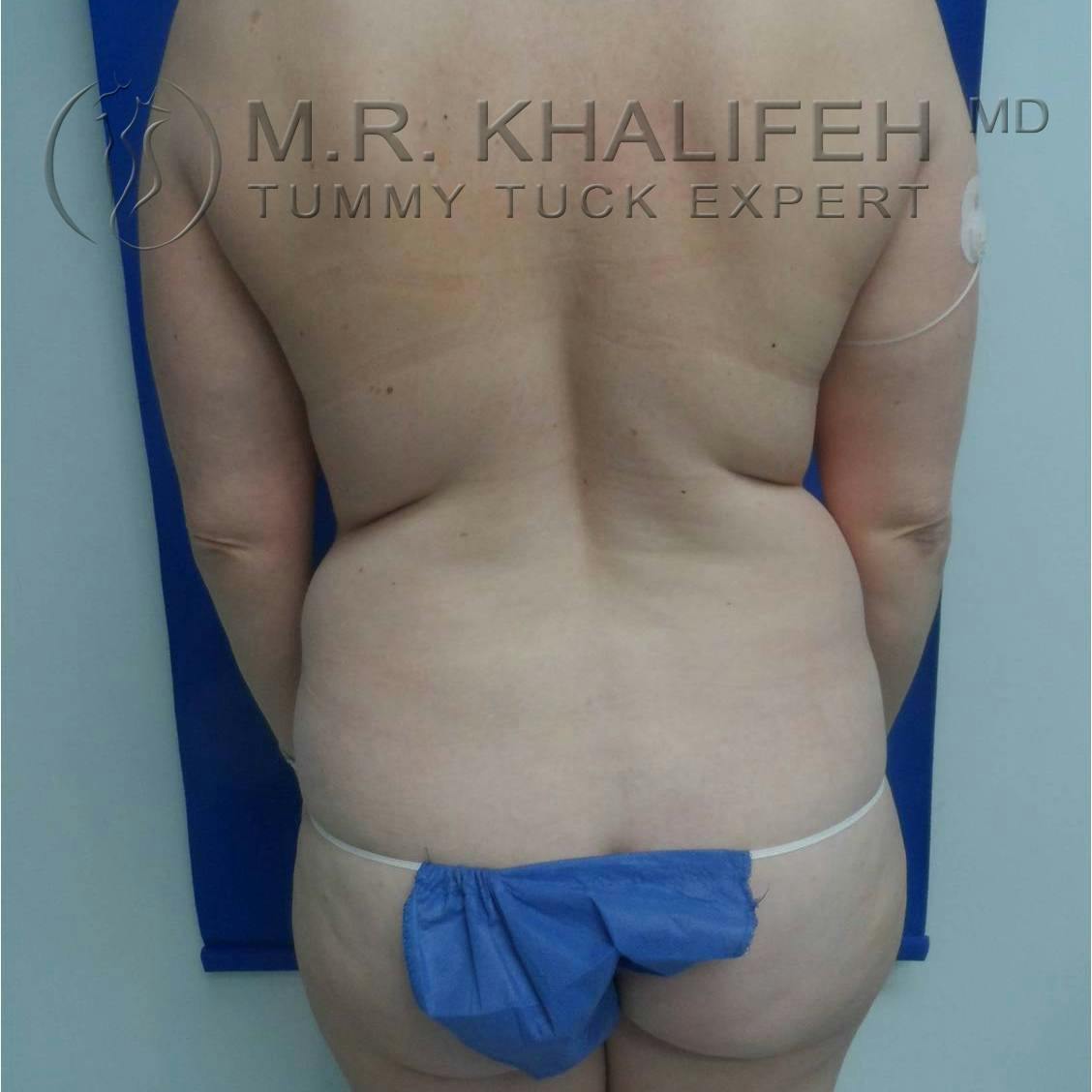 Tummy Tuck Gallery - Patient 3762071 - Image 5