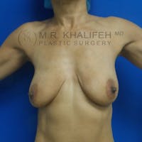 Breast Lift Gallery - Patient 3762073 - Image 1