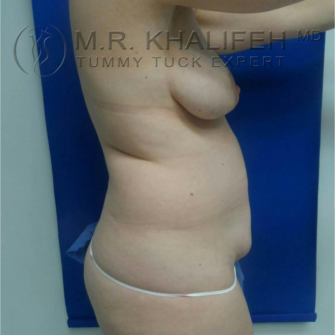Tummy Tuck Gallery - Patient 3762071 - Image 7