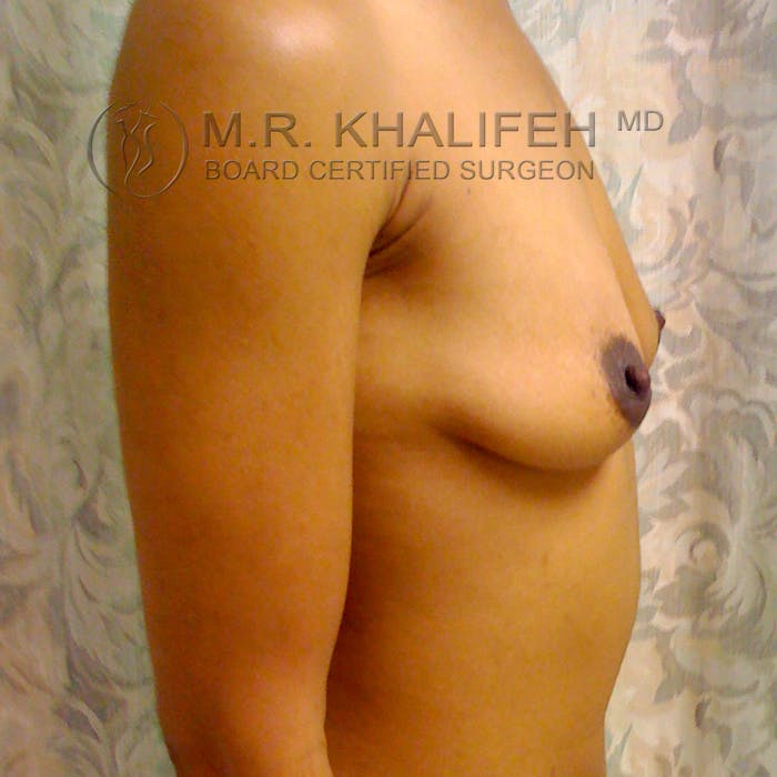 Breast Augmentation Gallery - Patient 3762072 - Image 3