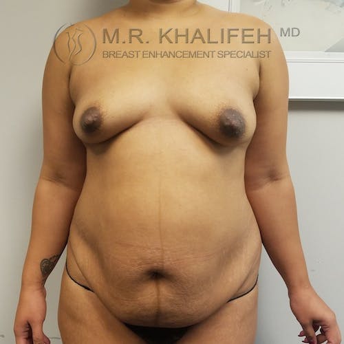 Breast Augmentation Gallery - Patient 3762075 - Image 1